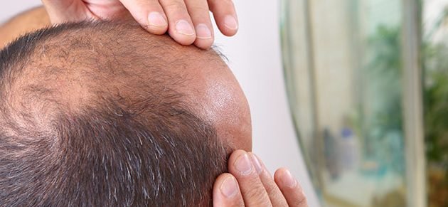 dispelling the myths about hair transplants
