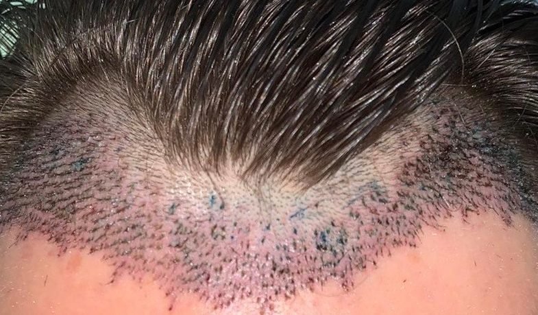 grow your confidence with hair transplantation 1