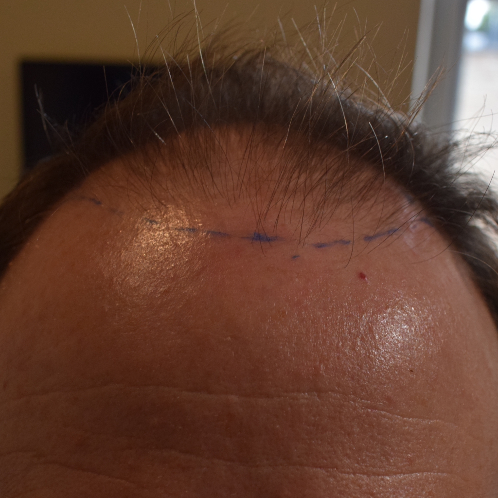 hair transplant surgery how to prepare