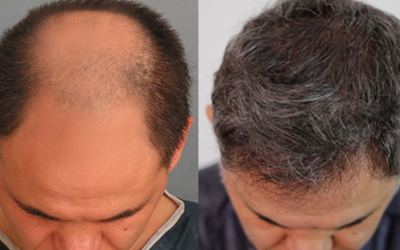 how hair transplant surgery can restore hair