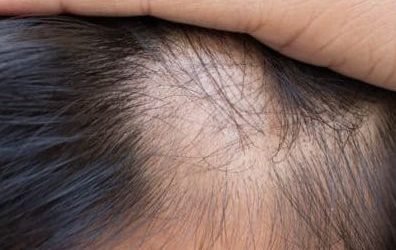 reaping the rewards of hair restoration surgery