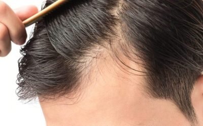 the benefits of hair transplant surgery 1