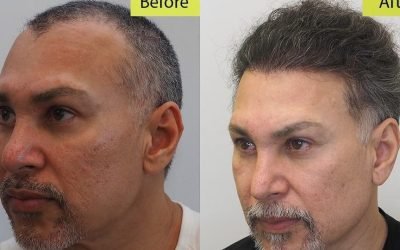 the cost of hair transplant surgery