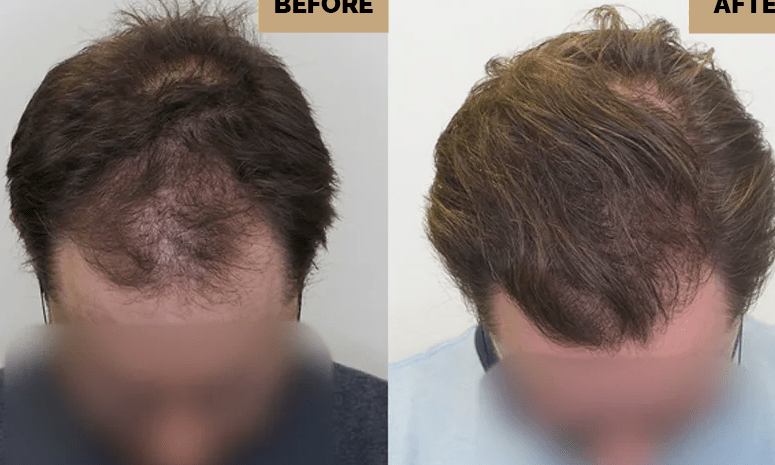 unlocking the potential of hair transplantation to restore lost hair
