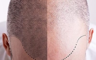 what to consider before getting a hair transplant 2