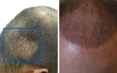 what to expect after a hair transplant surgery 2